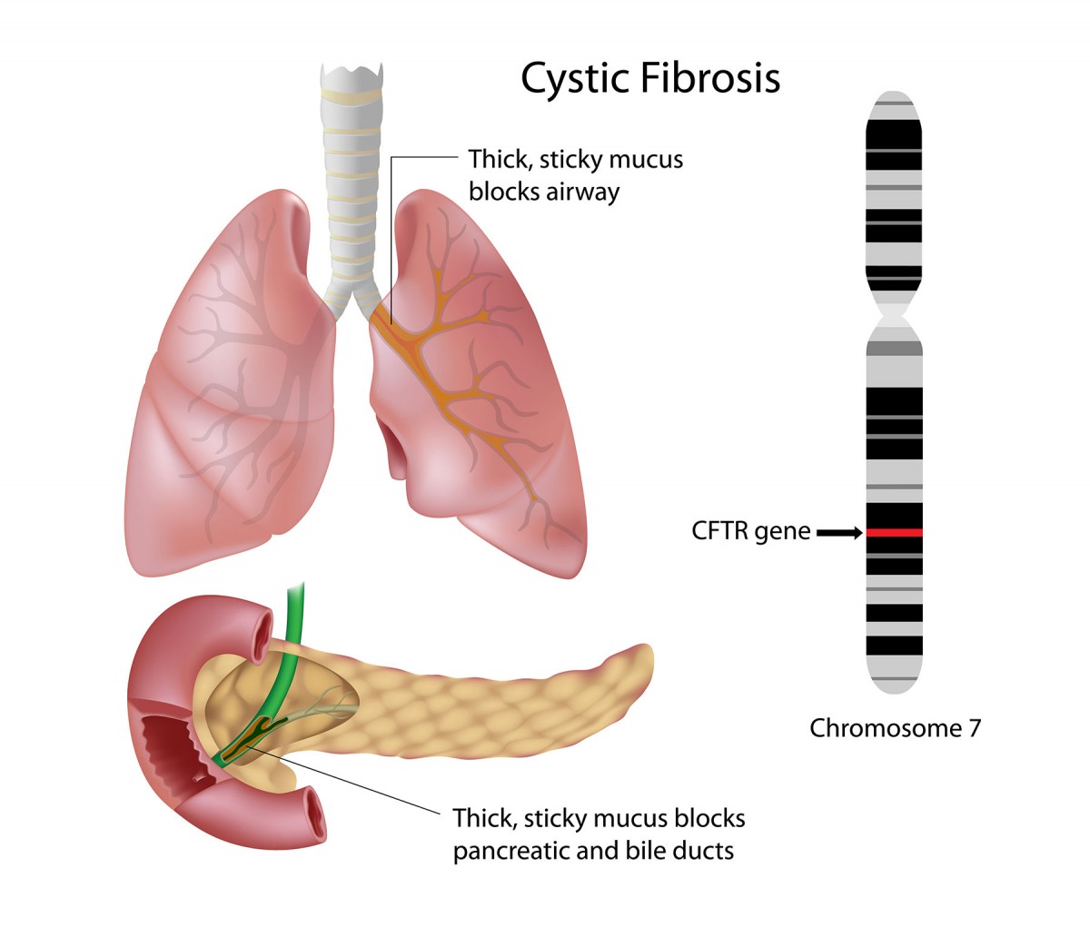 understanding-and-managing-cystic-fibrosis-home-salt-therapy-cystic